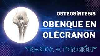 Osteosíntesis - Obenque en olécranon "Banda a tensión"