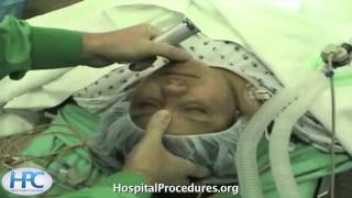 Orotracheal Intubation Video