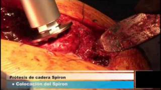 Chirurgie: Spiron OP Mexico - Part III -