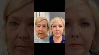 FACELIFT TRANSFORMATION - HER CONFIDENCE IS BACK! #plasticsurgery