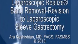 Laparoscopic Realize® Band Removal-Revision to Sleeve Gastrectomy