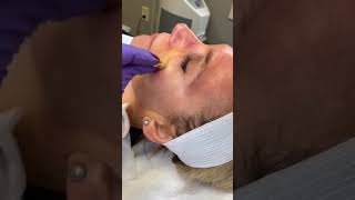 VI Peel with Dr. Krummen