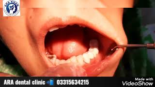 replacement of missing teeth with fixed teeth