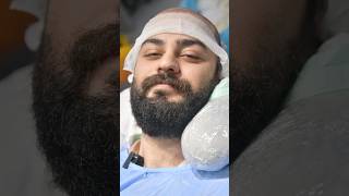 HAIR TRANSPLANT AFTER 6 MONTHS | HAIR TRANSPLANT RESULT