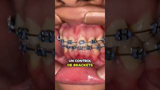 CONTROL DE BRACKETS