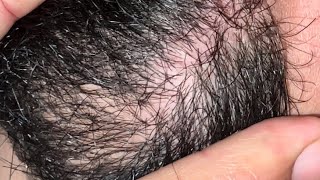 ASMR hair satisfying vedio face part 1 | ingrown  10 ingrown