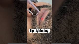 Dark Lip treatment #lips #darklipstreatment #expertdermatologist #liplightening