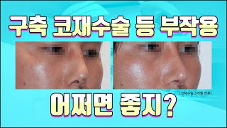 구축코수술 재수술 어떻게 해야될까? 코수술 부작용 구축현상.