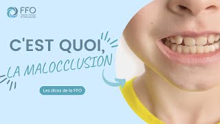 Orthodontie : c'est quoi, la malocclusion ?