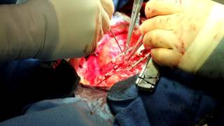 Open Heart Bypass Surgery - Alexander R. Marmureanu MD