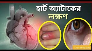 এক মাস আগে থেকেই দেখা যায় হার্ট অ্যাটাকের লক্ষণ | Sign Of health attack & Treatments