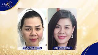 Foto facial 2019 - Nâng cơ - xóa nhăn - tạo mặt Vline