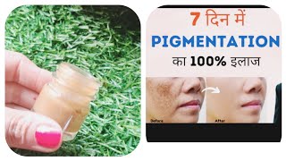 Pigmentation Melasma काले धब्बे झाइयाँ का 100% इलाज Natural Home Remedy से