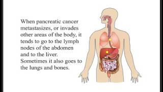 Pancreatic Cancer 006