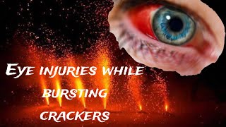 Eye injuries due to CRACKERS/ Bursting crackers can cause eye injuries