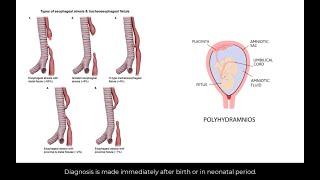 Types of esophageal atresia and tracheoesophageal fistula