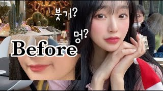 성공적인 입술필러 후기! 👄(1cc, 붓기, 멍, 1일차, 2일차, 3일차, 오버립 탈출, vlog)