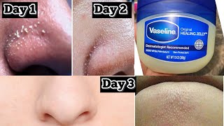 How to remove blackheads and Whiteheads from nose and face naturally at home