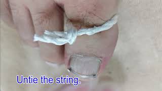 English v1: Ingrown toenail correction device "NailLift" on the surface procedure