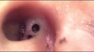 Removing large blackheads in the ear