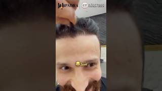 نتيجة زراعة الشعر في عيادة بادرا#before #beforeandafter #after #hairtransplant #padra #results ore