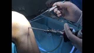 Пластика ПХЗ, артроскопія колінного суглобу, Joint surgery by doctor Roman Horobets