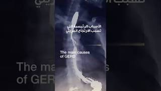 The main causes of GERD