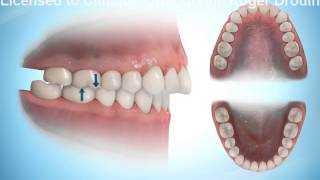 Mauvaise occlusion; écart entre les dents du haut et du bas