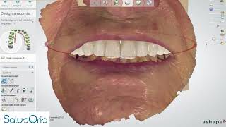 The "virtual patient" for 100% digital denture design.