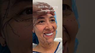 Unbelievable Crazy Plastic Surgery Transformation #plasticsurgeon #facelift