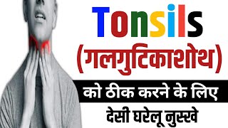 Tonsils (गलगुटिकाशोथ) को ठीक करने के लिए : देसी घरेलू नुस्खे