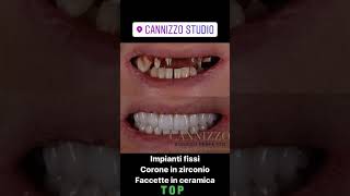 Impianti dentali - la soluzione