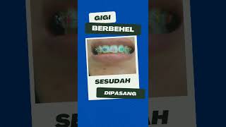 Pemasangan Behel Gigi