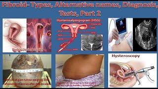 Fibroid  Types, Alternative names, Diagnosis, Tests, Part 2