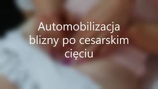 Autmobilizacja blizny po cesarskim cięciu