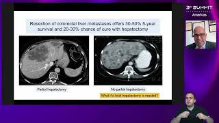 TRANSPLANTE MESA 2 Trans Hepático em Oncologia