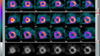 Gammagrama SPECT Cardiaco