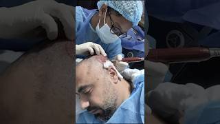 HAIR TRANSPLANT AFTER 5 MONTHS | HAIR TRANSPLANT RESULT