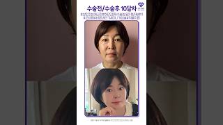 [상안검눈매교정+하안검(재수술) 눈밑지방재배채+쁘띠양악코성형+비공내리기+미니거상술+턱,볼지흡] 수술 과정 #Shorts