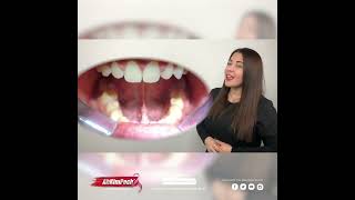 ¡CÓMO LIMPIAR TU RETENEDOR FIJO CON ORALB! POR LA DRA  JOANA CAMPOLARGO