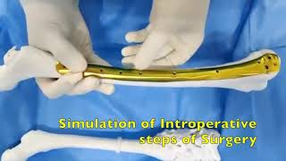 Planning for 3D Printing in Bone tumor surgery