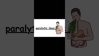 paralytic ileus #zerotofinals #nursing #medical #mbbs #neet  #nursingexam #bscnursing #gnm #aiims