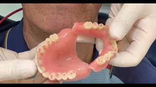 Removable complete and hybrid denture: fully digital