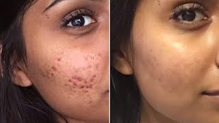 PIMPLE se hamesha ke liye chutkara ese milega/ hydra facial/smile up clinic rohtak