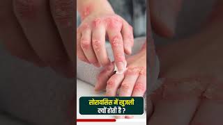 सोरायसिस में खुजली क्यों होती है ? | Why Does It Itch In Psoriasis? | Why Psoriasis Occurs #shorts