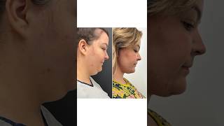 Drastic Plastic Surgery Transformation- Insane Necklift Results 🤯