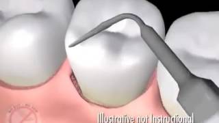 LANAP Laser Gum Surgery - Minimally Invasive Treatment for Periodontal Disease