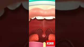 Tonsil stone removal