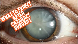 What to expect after Cataract Surgery