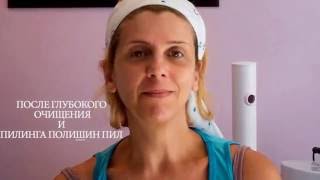 Микродермобразия с Полишен Пил Nu Skin